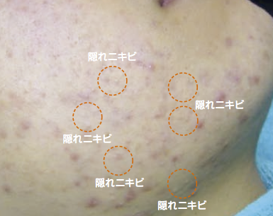 新しい にきび を作らないために 白崎医院blog 高岡市の皮ふ科 子どもの皮ふ 美容皮膚科