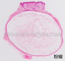 粉瘤の画像　よくある皮膚のでき物です。中には垢（アカ）がすこしずつ貯まるので、粉瘤も徐々に大きくなります。